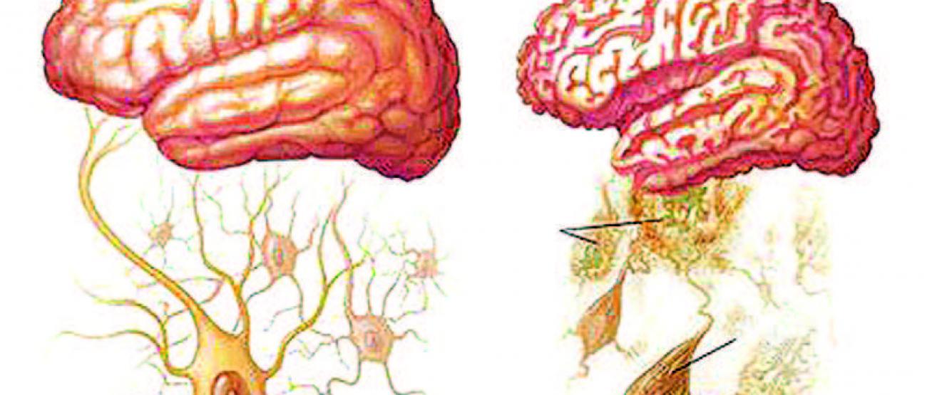 Healthy brain (left) versus an Alzheimer's brain (right)