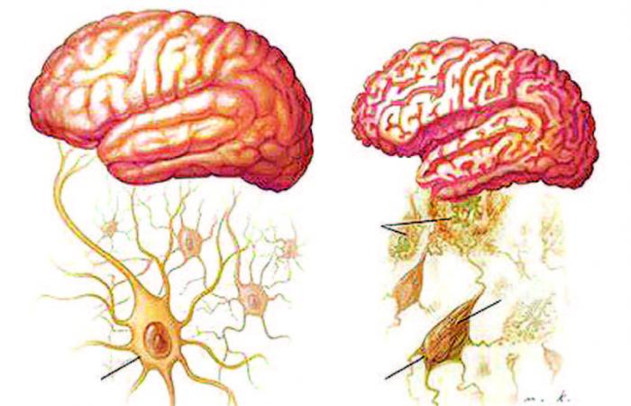 Healthy brain (left) versus an Alzheimer's brain (right)